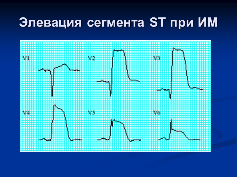 Элевация сегмента ST при ИМ